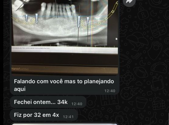 Conversa de WhatsApp do Alysson com planejamento de implantes e a mensagem: fechei ontem, 34 mil